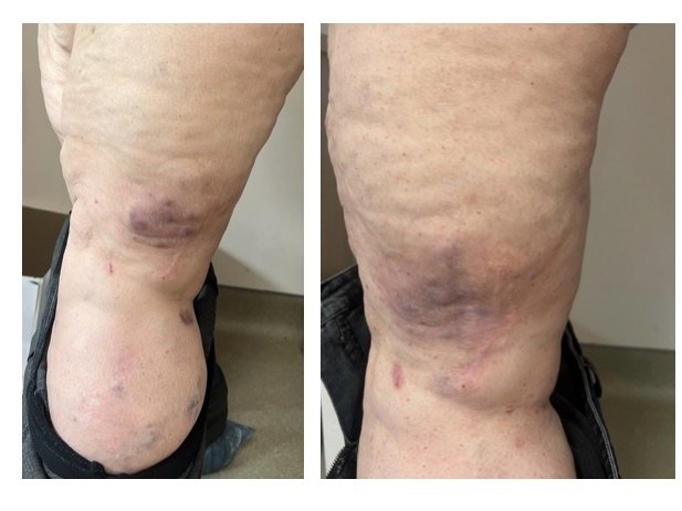 Фотографии бедра пациентки на фоне лечения, вид сзади