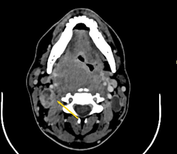 May 2023, before treatment
