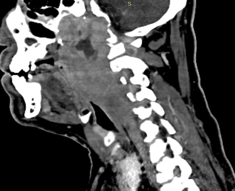 May 2023, before treatment